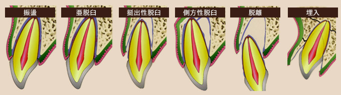 歯の外傷の種類を断面図で示したイラスト。左から振盪、亜脱臼、挺出性脱臼、側方性脱臼、脱離、埋入の6パターンを歯槽骨と歯肉の中の歯の位置関係で比較している。