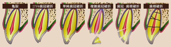 歯の破折の種類を断面図で示したイラスト。左から亀裂、エナメル質歯冠破折、単純歯冠破折、複雑歯冠破折、歯冠歯根破折、歯根破折の6パターンを比較している。